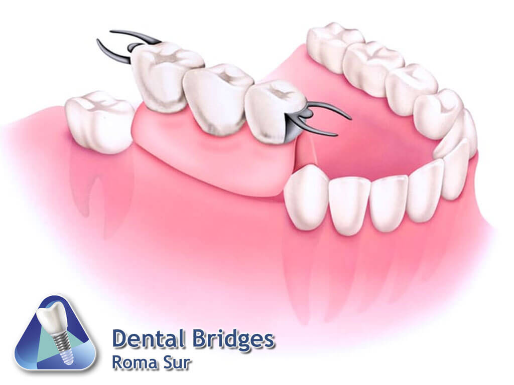 Dental Bridges Roma Sur