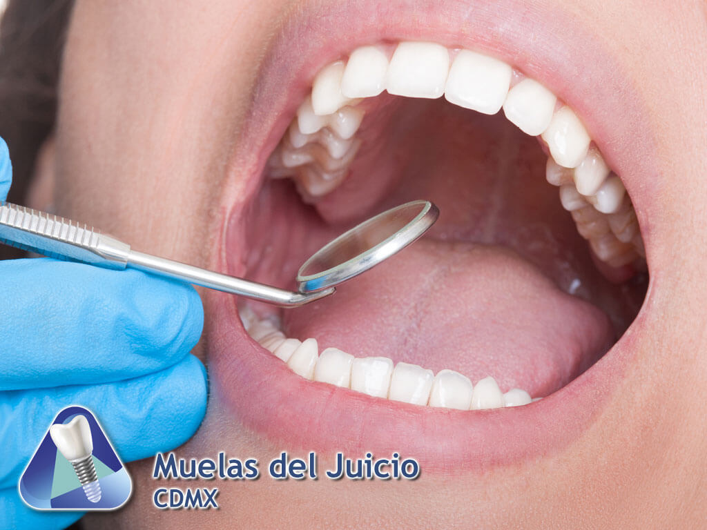 Muelas del Juicio CDMX